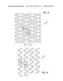 OFFSET PEAK-TO-PEAK STENT PATTERN diagram and image