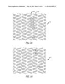 OFFSET PEAK-TO-PEAK STENT PATTERN diagram and image