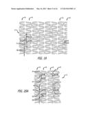 OFFSET PEAK-TO-PEAK STENT PATTERN diagram and image