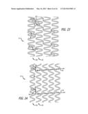 OFFSET PEAK-TO-PEAK STENT PATTERN diagram and image