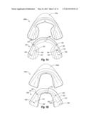 NON-CUSTOM DENTAL TREATMENT TRAYS HAVING IMPROVED ANATOMICAL FEATURES diagram and image