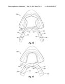 NON-CUSTOM DENTAL TREATMENT TRAYS HAVING IMPROVED ANATOMICAL FEATURES diagram and image