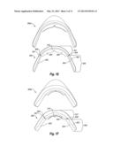 NON-CUSTOM DENTAL TREATMENT TRAYS HAVING IMPROVED ANATOMICAL FEATURES diagram and image