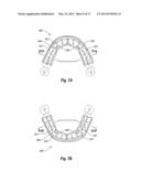 NON-CUSTOM DENTAL TREATMENT TRAYS HAVING IMPROVED ANATOMICAL FEATURES diagram and image