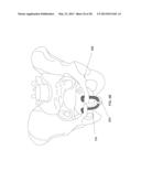 MEDICAL ASSEMBLY FOR DELIVERING AN IMPLANT diagram and image