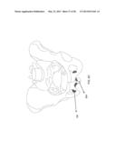 MEDICAL ASSEMBLY FOR DELIVERING AN IMPLANT diagram and image