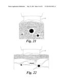 BLOOD VESSEL ACCESS SYSTEM AND DEVICE diagram and image