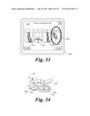 BLOOD VESSEL ACCESS SYSTEM AND DEVICE diagram and image