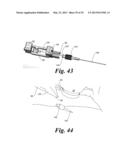 BLOOD VESSEL ACCESS SYSTEM AND DEVICE diagram and image