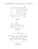 RECANALIZING OCCLUDED VESSELS USING RADIOFREQUENCY ENERGY diagram and image