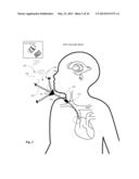 SYSTEMS, DEVICES, AND METHODS INCLUDING INFECTION-FIGHTING AND MONITORING     SHUNTS diagram and image