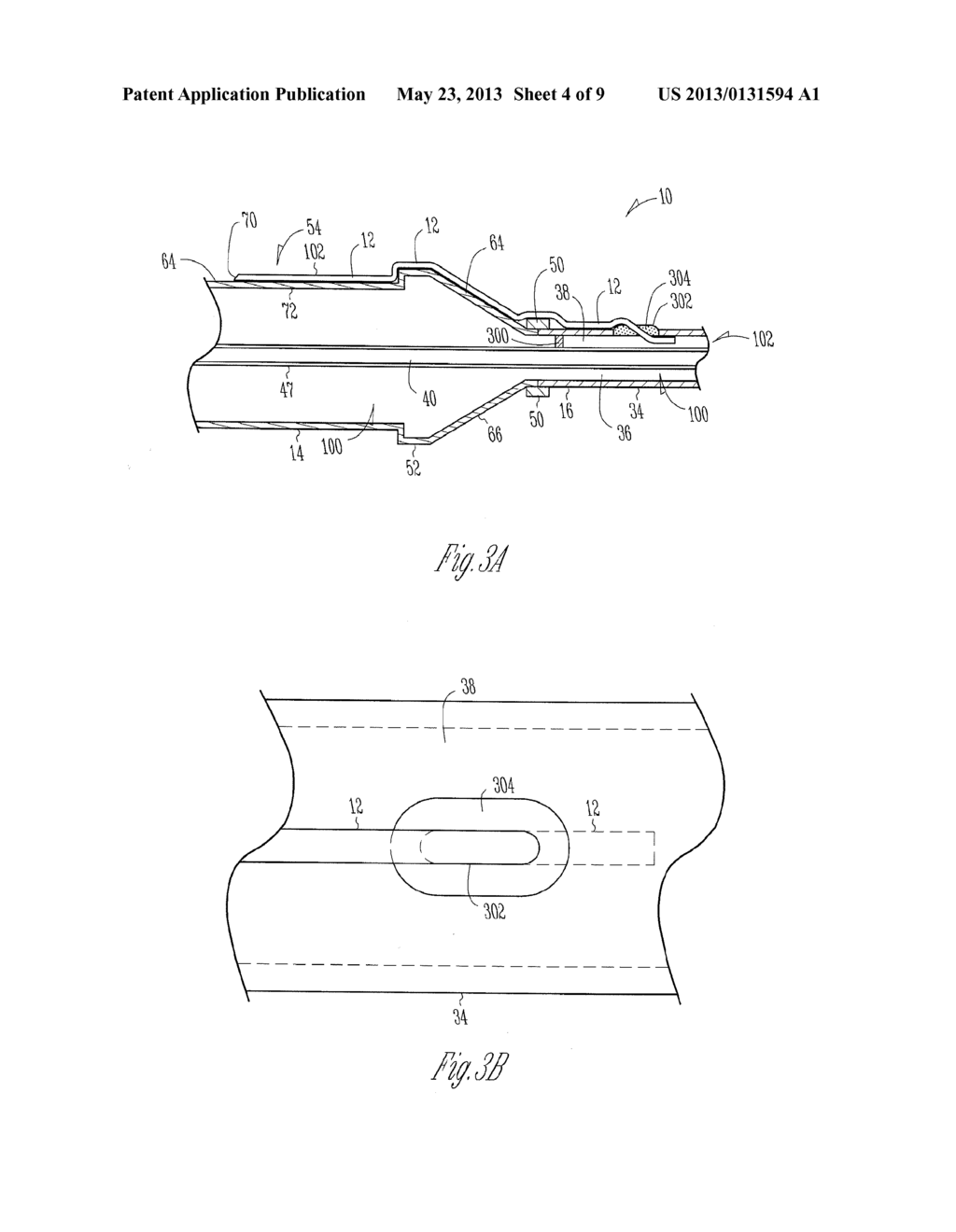 BALLOON CATHETER WITH EXTERNAL DELIVERY TUBE - diagram, schematic, and image 05