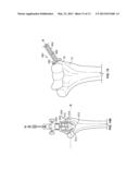 Patient-Specific Elbow Guides And Associated Methods diagram and image