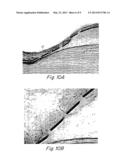 METALLIC IMPLANTABLE GRAFTS AND METHOD OF MAKING SAME diagram and image