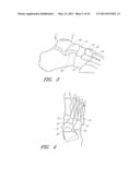 CATHETER DELIVERABLE FOOT IMPLANT AND METHOD OF DELIVERING THE SAME diagram and image