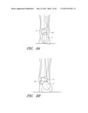 CATHETER DELIVERABLE FOOT IMPLANT AND METHOD OF DELIVERING THE SAME diagram and image