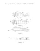 HAMMERTOE IMPLANT diagram and image