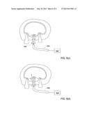 DENTAL IMPLANTS, DEVICES AND METHODS ASSOCIATED WITH DENTAL IMPLANTATION     PROCEDURES diagram and image