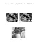 Intravascular Tissue Disruption diagram and image