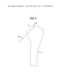 Arthroplasty Instruments and Associated Method diagram and image