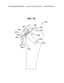 Arthroplasty Instruments and Associated Method diagram and image