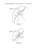 DEVICE AND METHOD FOR SUTURING INTRACARDIAC DEFECTS diagram and image
