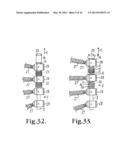 Dynamic stabilization assembly having pre-compressed spacers with     differential displacements diagram and image