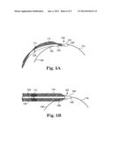 SURGICAL ARTICLES AND METHODS FOR TREATING PELVIC CONDITIONS diagram and image