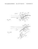 SURGICAL ARTICLES AND METHODS FOR TREATING PELVIC CONDITIONS diagram and image