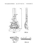 FRACTURE FIXATION SYSTEM diagram and image