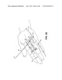 METHOD AND APPARATUS FOR REPAIRING A TENDON OR LIGAMENT diagram and image