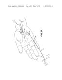 METHOD AND APPARATUS FOR REPAIRING A TENDON OR LIGAMENT diagram and image