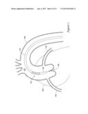 EXPANDING DISTAL SHEATH WITH COMBINED EMBOLIC PROTECTION diagram and image