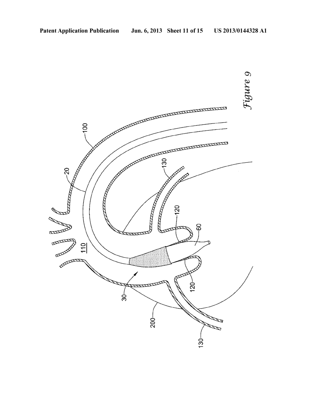 EXPANDING DISTAL SHEATH WITH COMBINED EMBOLIC PROTECTION - diagram, schematic, and image 12