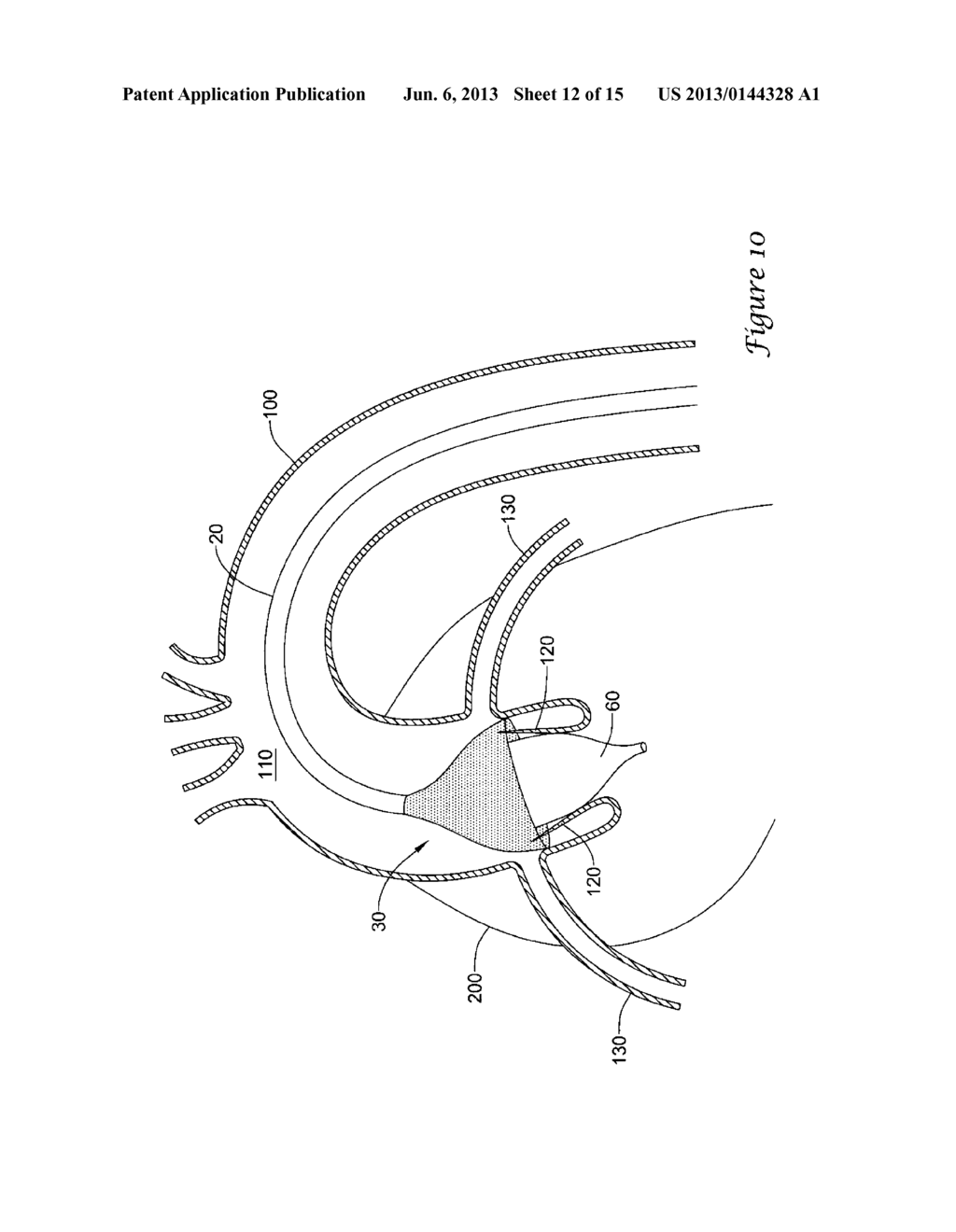 EXPANDING DISTAL SHEATH WITH COMBINED EMBOLIC PROTECTION - diagram, schematic, and image 13