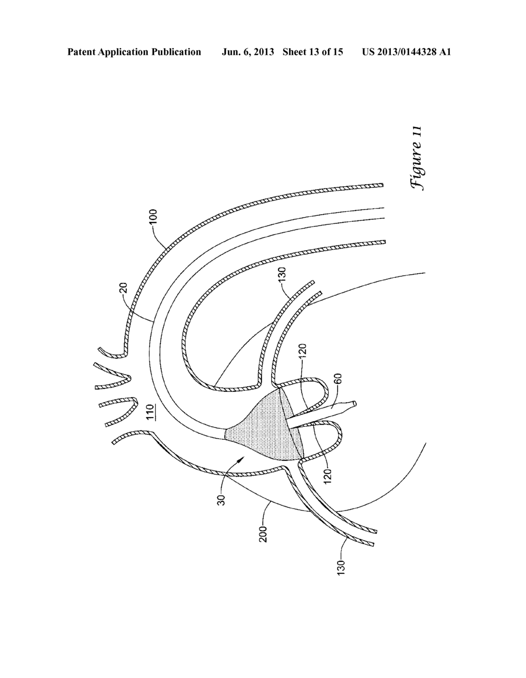 EXPANDING DISTAL SHEATH WITH COMBINED EMBOLIC PROTECTION - diagram, schematic, and image 14