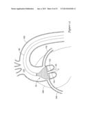 EXPANDING DISTAL SHEATH WITH COMBINED EMBOLIC PROTECTION diagram and image