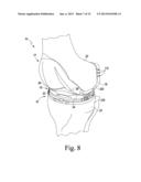 FEMORAL TRIAL COMPONENT diagram and image