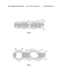 HETEROGENEOUS PROPPANT PLACEMENT IN A FRACTURE WITH REMOVABLE     EXTRAMETRICAL MATERIAL FILL diagram and image