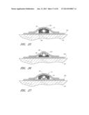 MEDICAL DEVICE SECUREMENT SYSTEM diagram and image