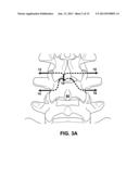 MULTIPLE PATHWAYS FOR SPINAL NERVE ROOT DECOMPRESSION FROM A SINGLE ACCESS     POINT diagram and image