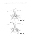 MULTIPLE PATHWAYS FOR SPINAL NERVE ROOT DECOMPRESSION FROM A SINGLE ACCESS     POINT diagram and image