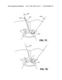 MULTIPLE PATHWAYS FOR SPINAL NERVE ROOT DECOMPRESSION FROM A SINGLE ACCESS     POINT diagram and image