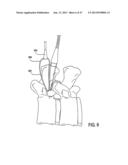 TISSUE MODIFICATION DEVICES AND METHODS diagram and image