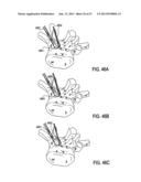 TISSUE MODIFICATION DEVICES AND METHODS diagram and image