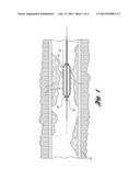 CATHETER SYSTEM WITH BALLOON-MOUNTED PLAQUE-MODIFYING ELEMENTS diagram and image