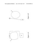 SUBCUTANEOUS DEFIBRILLATOR IMPLANTATION diagram and image