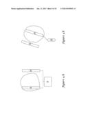 SUBCUTANEOUS DEFIBRILLATOR IMPLANTATION diagram and image