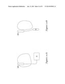 SUBCUTANEOUS DEFIBRILLATOR IMPLANTATION diagram and image