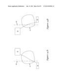 SUBCUTANEOUS DEFIBRILLATOR IMPLANTATION diagram and image